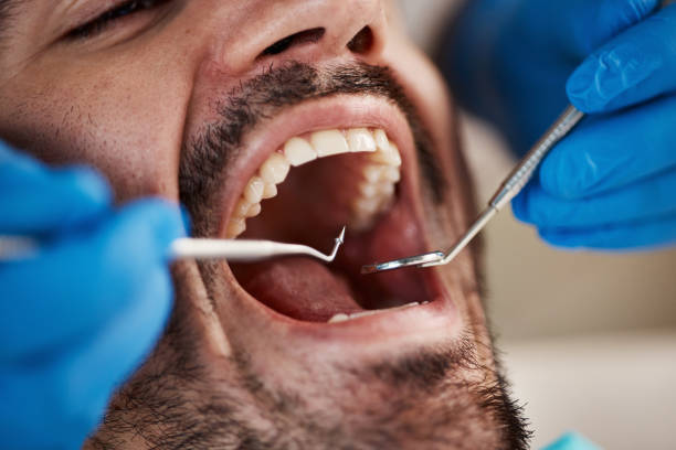 Best Dental Abscess Treatment in Reno, TX